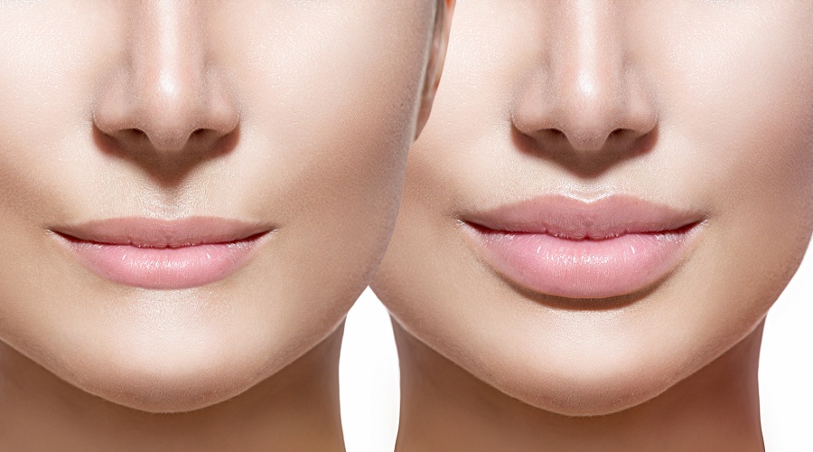 Lip Reduction Lip Reduction image